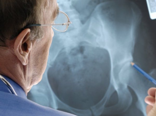RTG-képen mutat kék ceruzával egy orvos a combcsontnál súlyos csontritkulást.