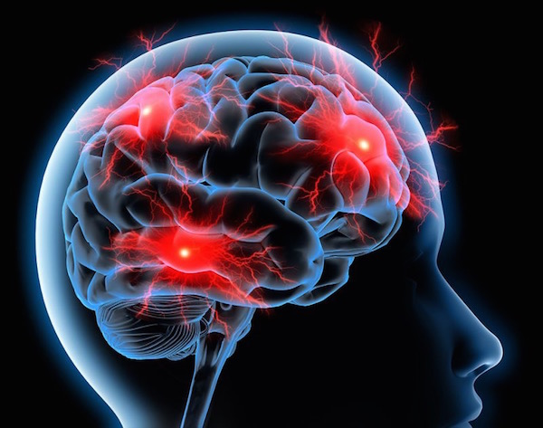 Az agy ereiben lévő migrénes fejfájás sematikus ábrázolása.