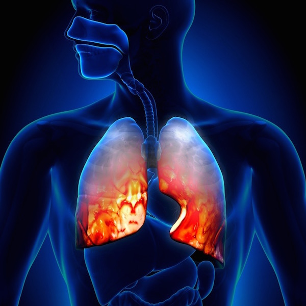 Tüdőgyulladás (pneunomia) megjelenítése egy sematikus ábrán.
