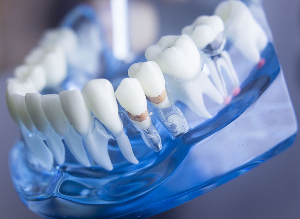 Kék műanyagba ágyazott fogsor, melyen bemutatják a fogkőképződést, a csontfelszívódást és a granulóma kialakulási helyeit.