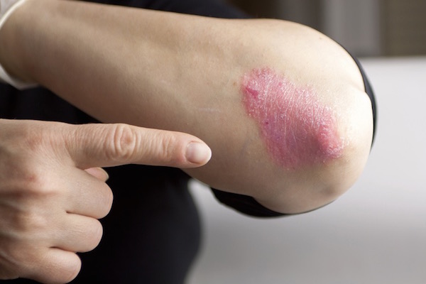 bőrbetegség pikkelysömör otthoni kezelés