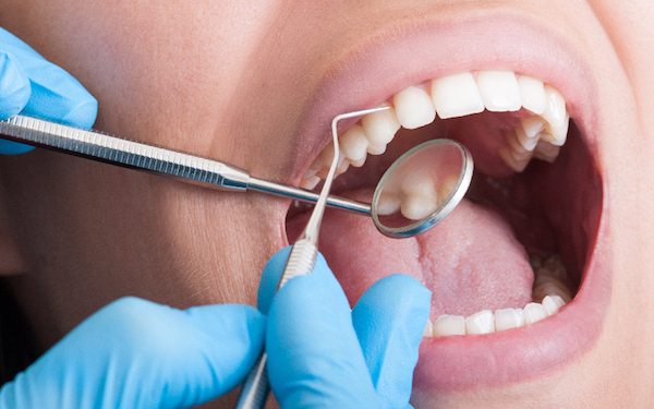 Fogorvos ellenőrzi páciense fogait szondával és tükörrel, kék gumikesztyűben.