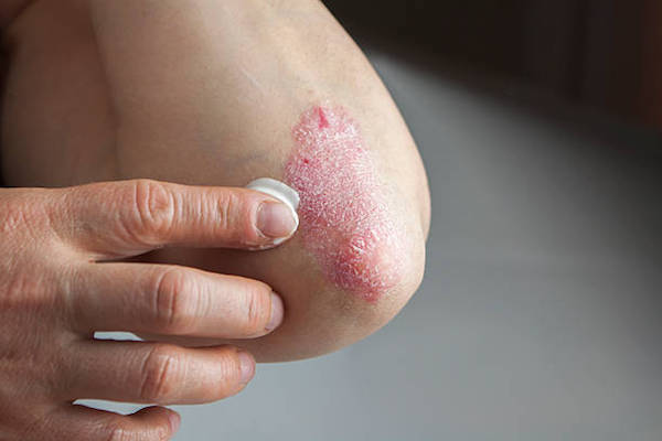hogyan lehet eltávolítani a vörös foltokat a streptoderma után vitiligo autoimmun betegség