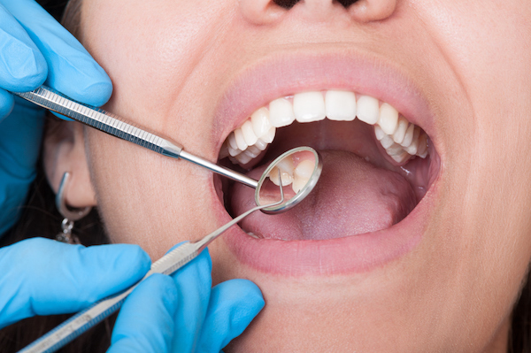 Fogászati kontrollvizsgálaton nézi a fogorvos egy hölgy fogait szondával és tükörrel.
