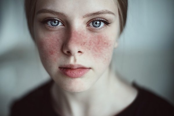 Lupusszal küzdő fiatal lány bőrkiütésekkel az arcán.