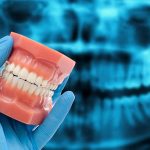 A fogak csikorgatása elleni módszerek