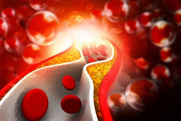 Egy imitált ér, amelyen belül koleszterinplakkok lerakódása látható, mellette imitált vörösvértestek mozognak.