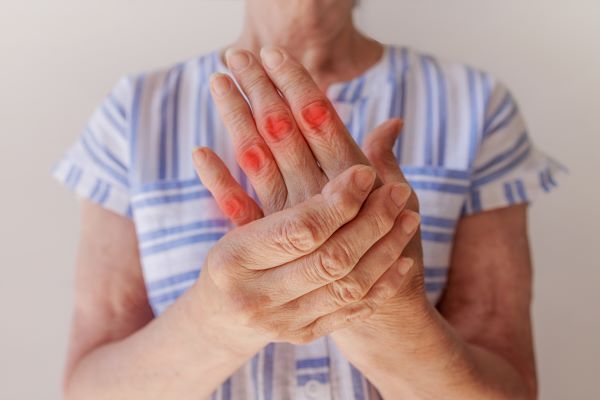Idős nő kék-fehér csíkos felsőben fogja a kézfejét, amelyen pirosak az ujjízületek.