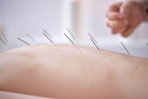Bőrből kiálló akupunktúrás tűk.