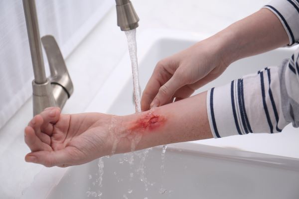 Nő a megégett alkarját folyó víz alá tartja a mosogatónál.